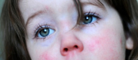 Скарлатина